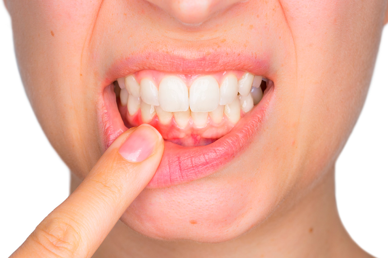CAUSAS DE LA PERIODONTITIS