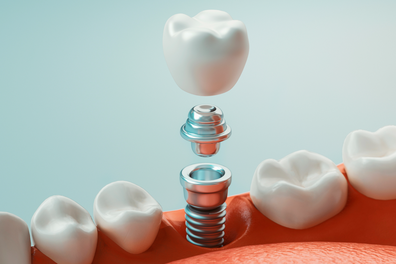 TIPOS DE IMPLANTES DENTALES